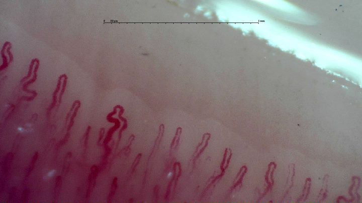 A capillary with two broad bends near the left-center, beside finer elongated hairpin loops.