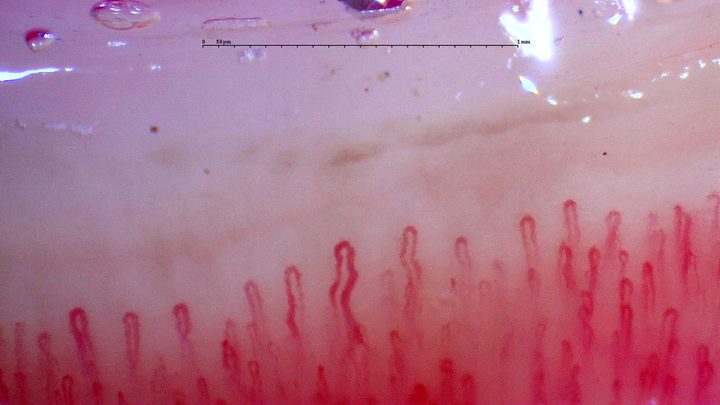 An enlarged, mildly tortuous capillary near the center, beside finer hairpin loops with rounded apices.