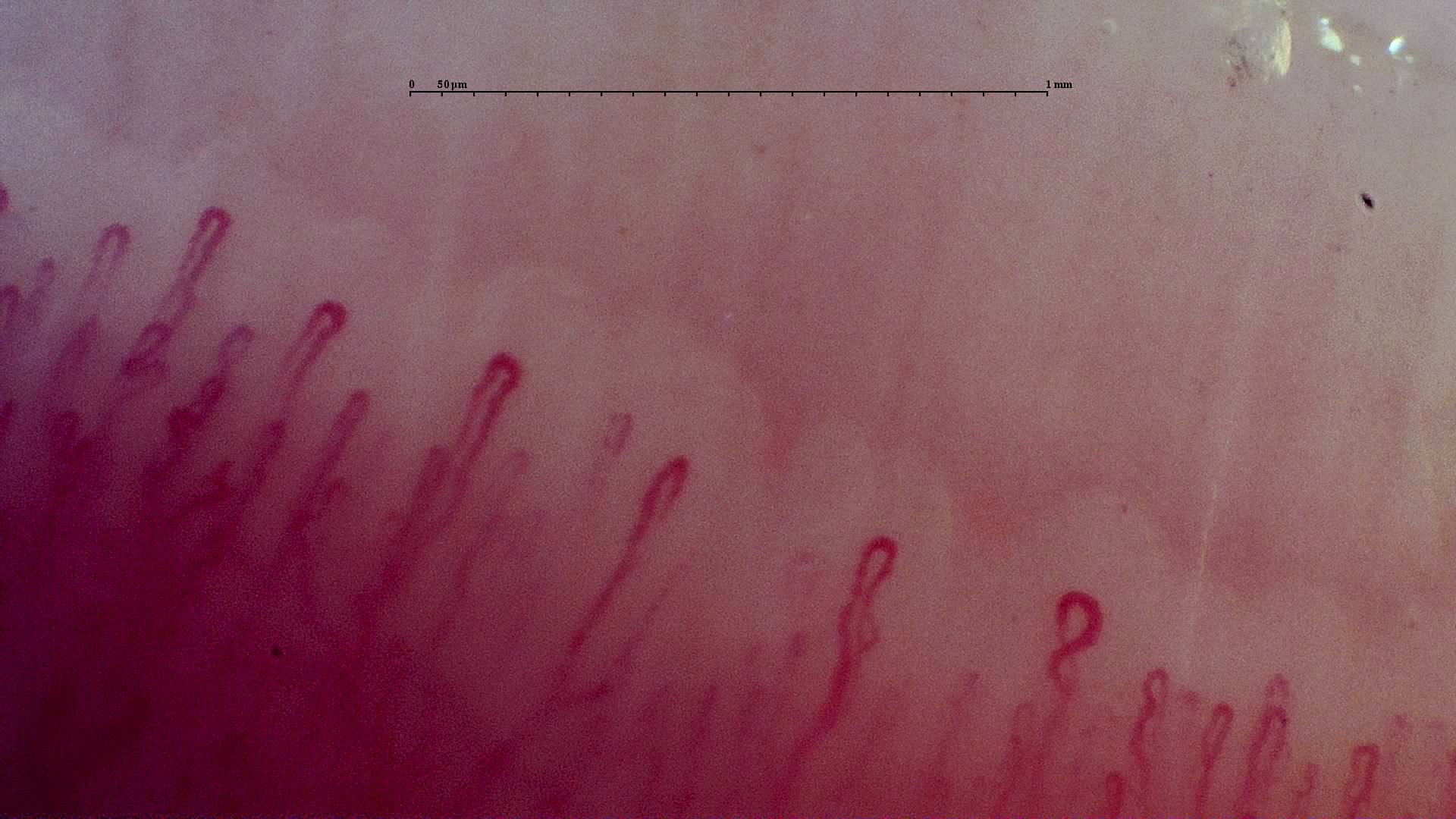 An oval crossed capillary right of center, among elongated hairpin loops with occasional mild bends.