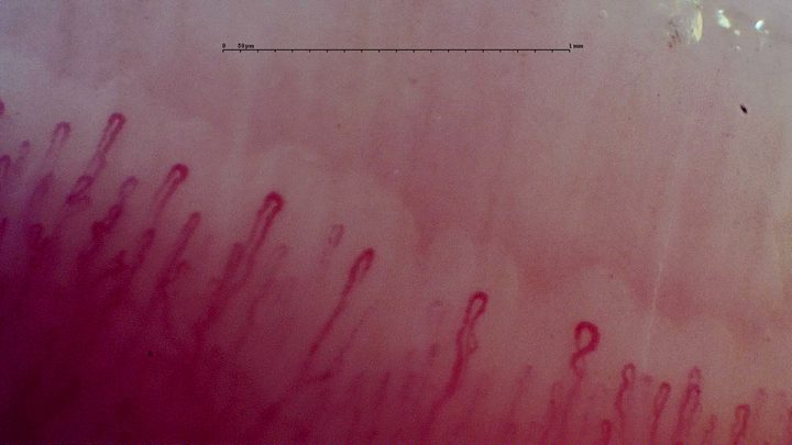 An oval crossed capillary right of center, among elongated hairpin loops with occasional mild bends.