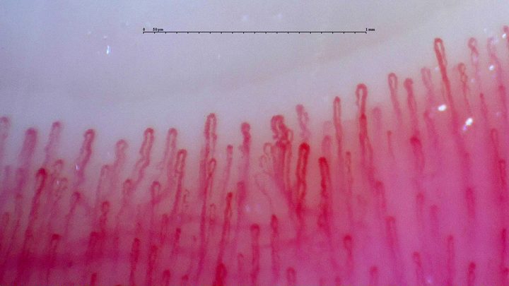 A small group of twisted loops near the center, surrounded by taller hairpin capillaries of different widths.