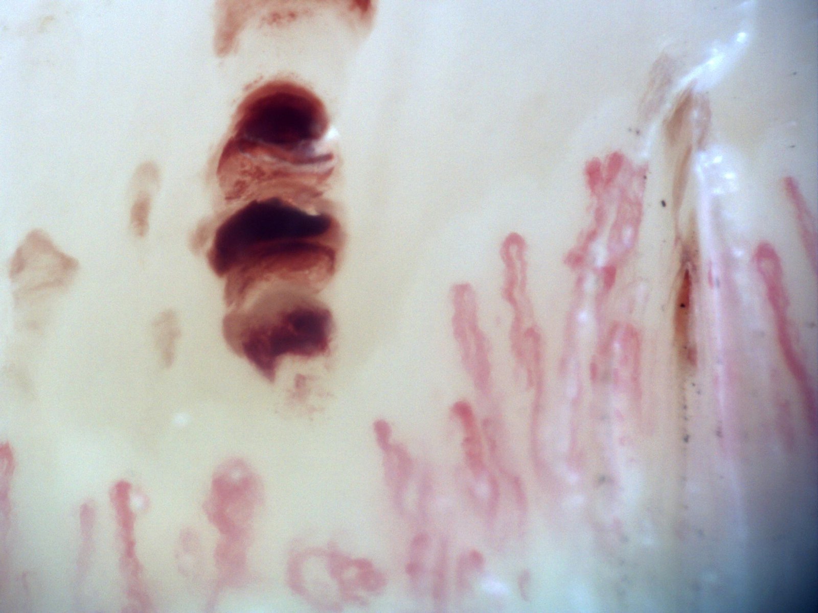 Microvascular hemorrhage as a morphological example