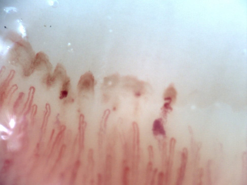 Capillaroscopy in an anticoagulated patient showing preserved density and hemorrhages without giant capillaries