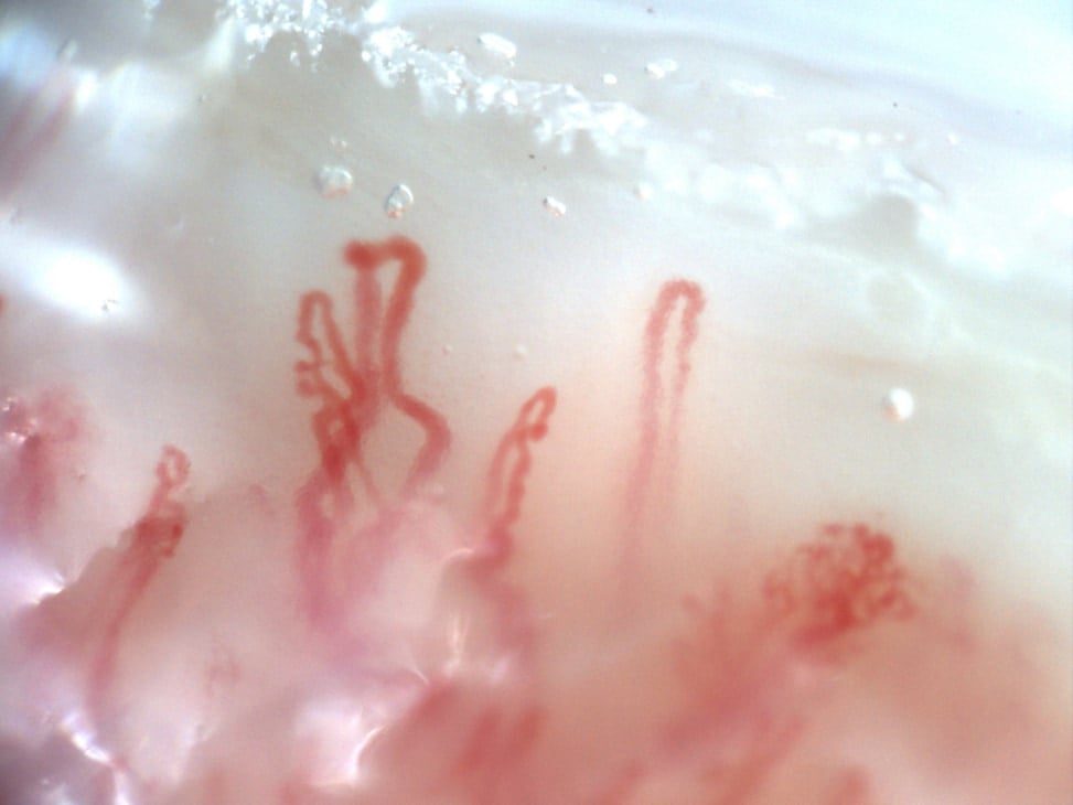 Dermatomyositis with giant and ramified capillaries