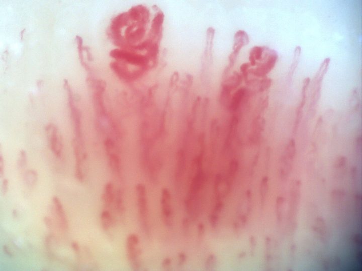 200x capillaroscopy field showing a giant capillary with a coiled appearance