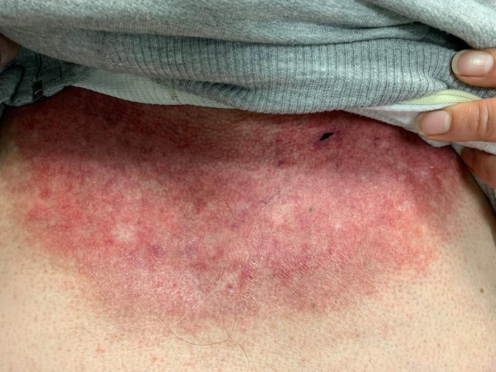 Skin lesions in V-neck distribution