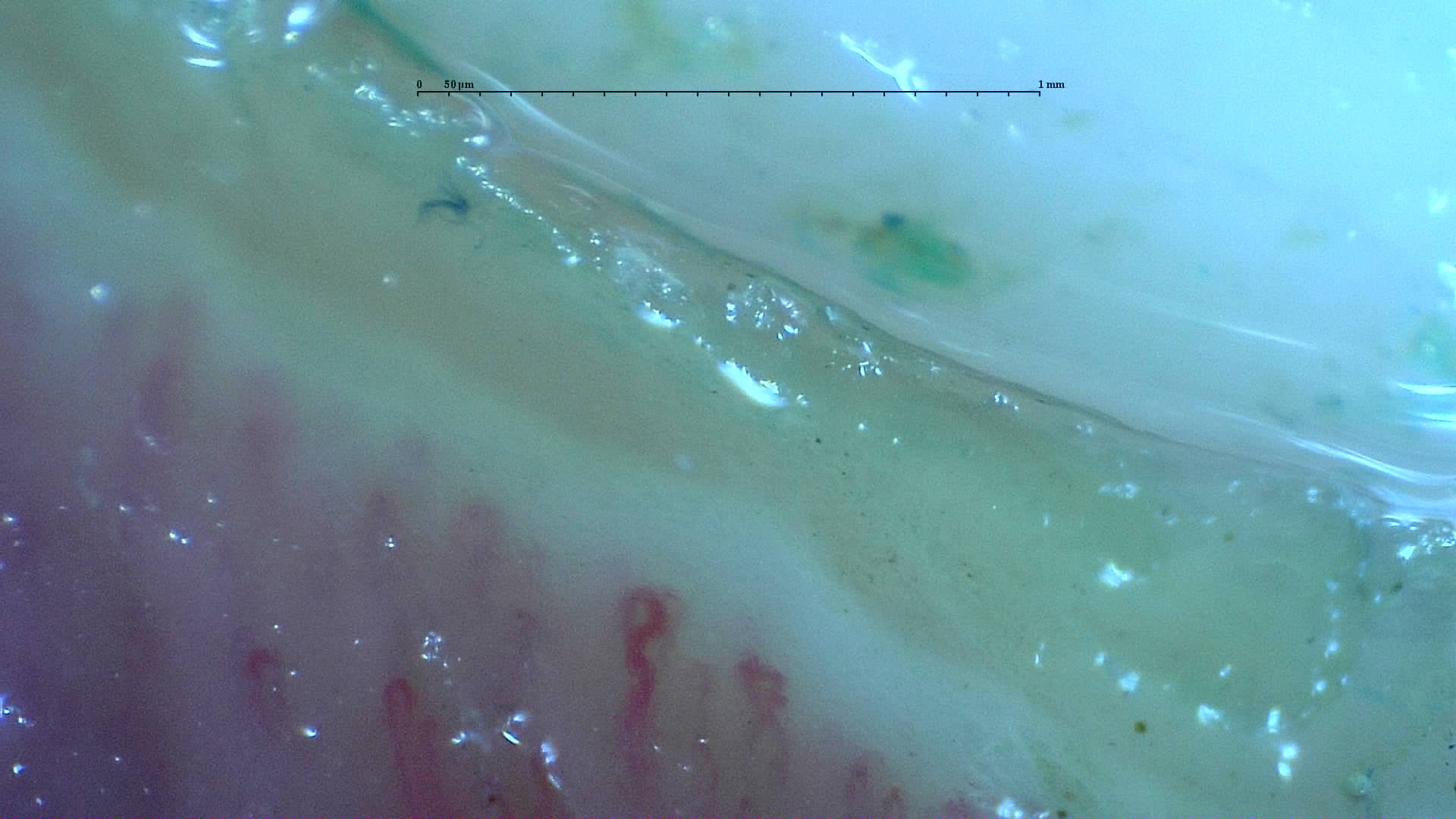 Nailfold capillaroscopy: right middle finger, field d. Mixed Connective Tissue Disease with an Unclassifiable Scleroderma-Like Pattern.