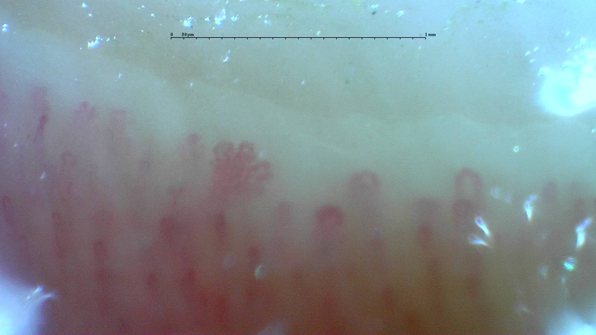 Nailfold capillaroscopy: right ring finger, field d. Mixed Connective Tissue Disease with an Unclassifiable Scleroderma-Like Pattern.