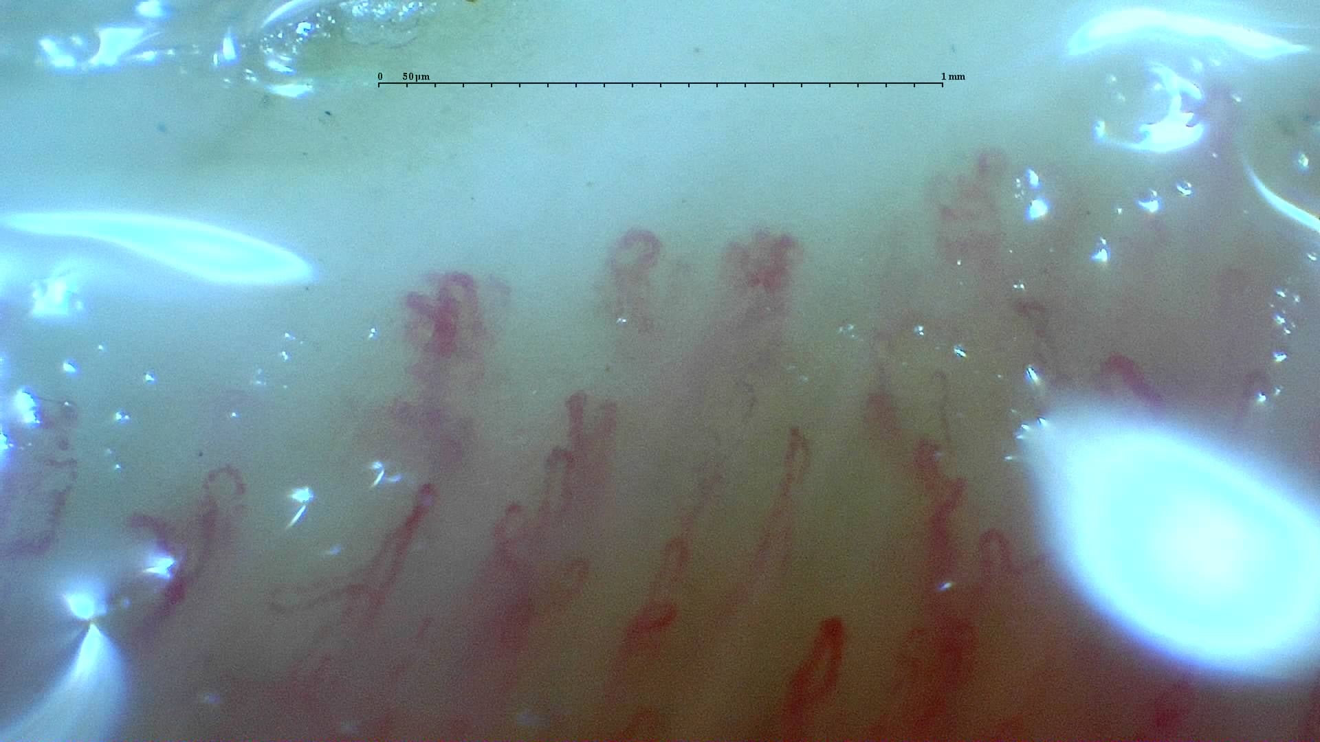 Nailfold capillaroscopy: left middle finger, field a. Mixed Connective Tissue Disease with an Unclassifiable Scleroderma-Like Pattern.