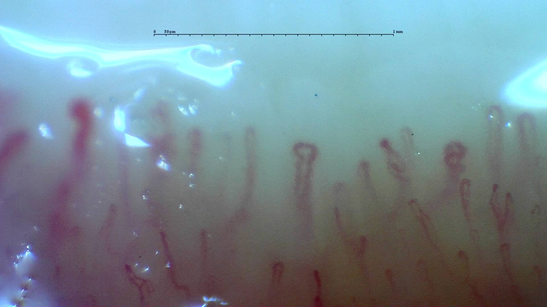 Nailfold capillaroscopy: left little finger, field c. Mixed Connective Tissue Disease with an Unclassifiable Scleroderma-Like Pattern.