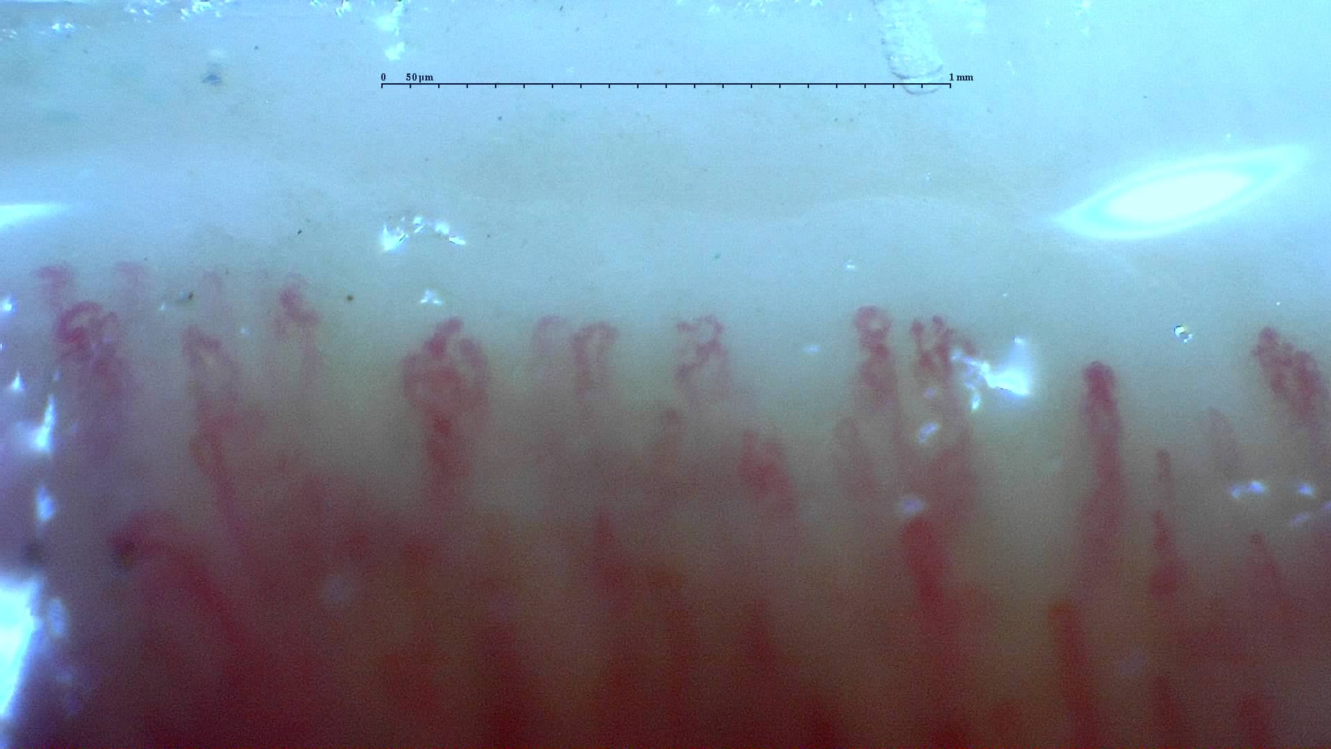 Nailfold capillaroscopy: right middle finger, field c. Mixed Connective Tissue Disease with an Unclassifiable Scleroderma-Like Pattern.