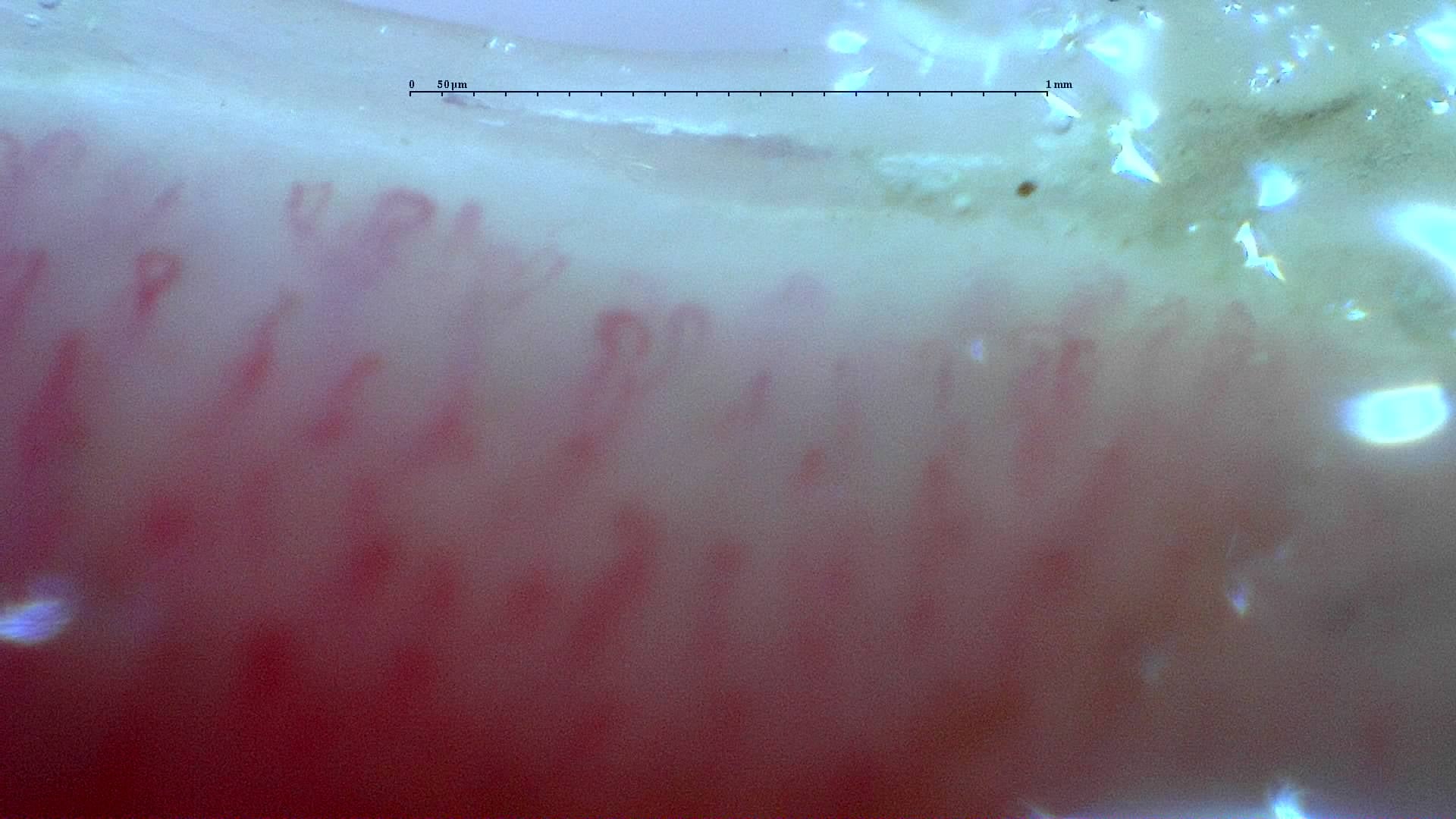 Nailfold capillaroscopy: left index finger, field b. Mixed Connective Tissue Disease with an Unclassifiable Scleroderma-Like Pattern.