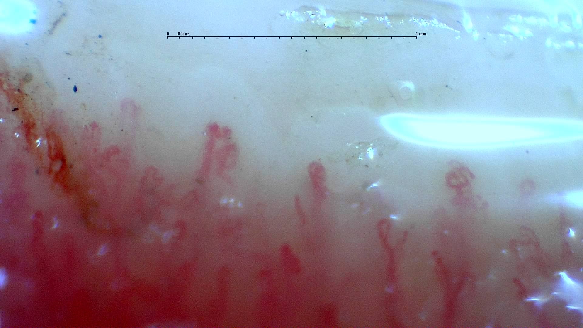 Nailfold capillaroscopy: left middle finger, field c. Mixed Connective Tissue Disease with an Unclassifiable Scleroderma-Like Pattern.