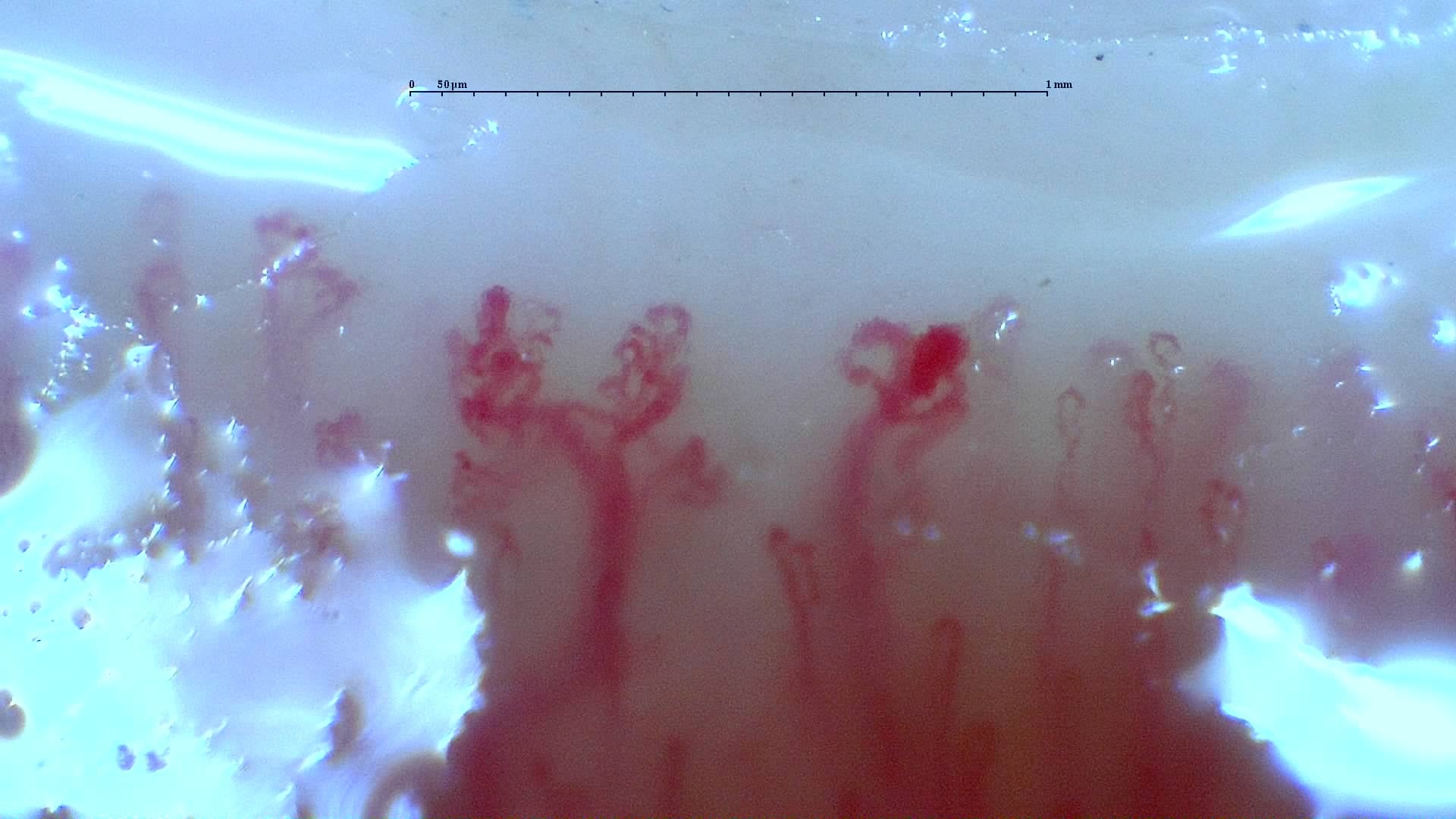Nailfold capillaroscopy: right little finger, field b. Mixed Connective Tissue Disease with an Unclassifiable Scleroderma-Like Pattern.