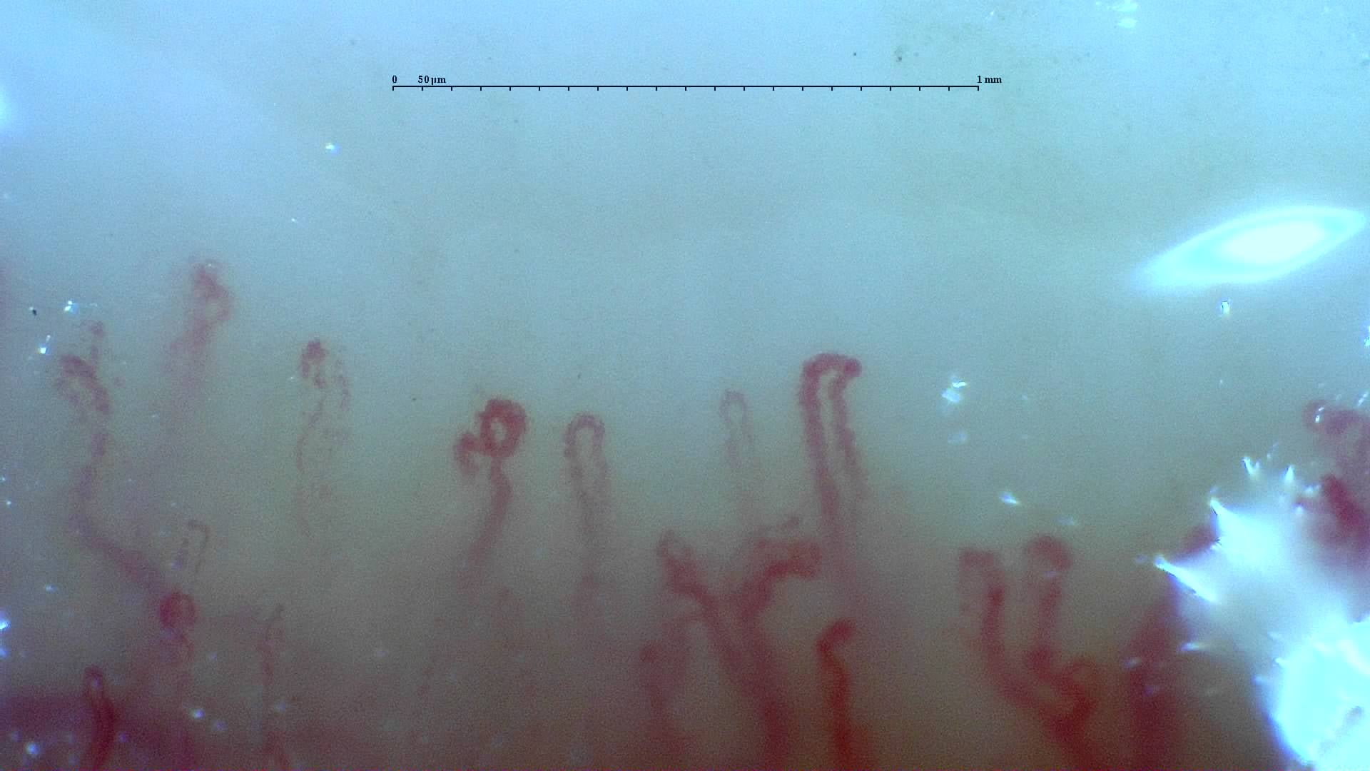 Nailfold capillaroscopy: left ring finger, field c. Mixed Connective Tissue Disease with an Unclassifiable Scleroderma-Like Pattern.