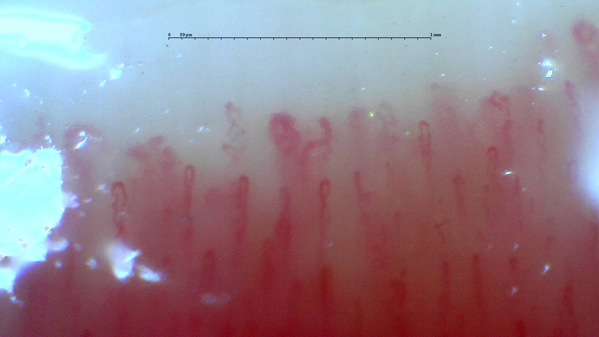Nailfold capillaroscopy: right ring finger, field a. Mixed Connective Tissue Disease with an Unclassifiable Scleroderma-Like Pattern.
