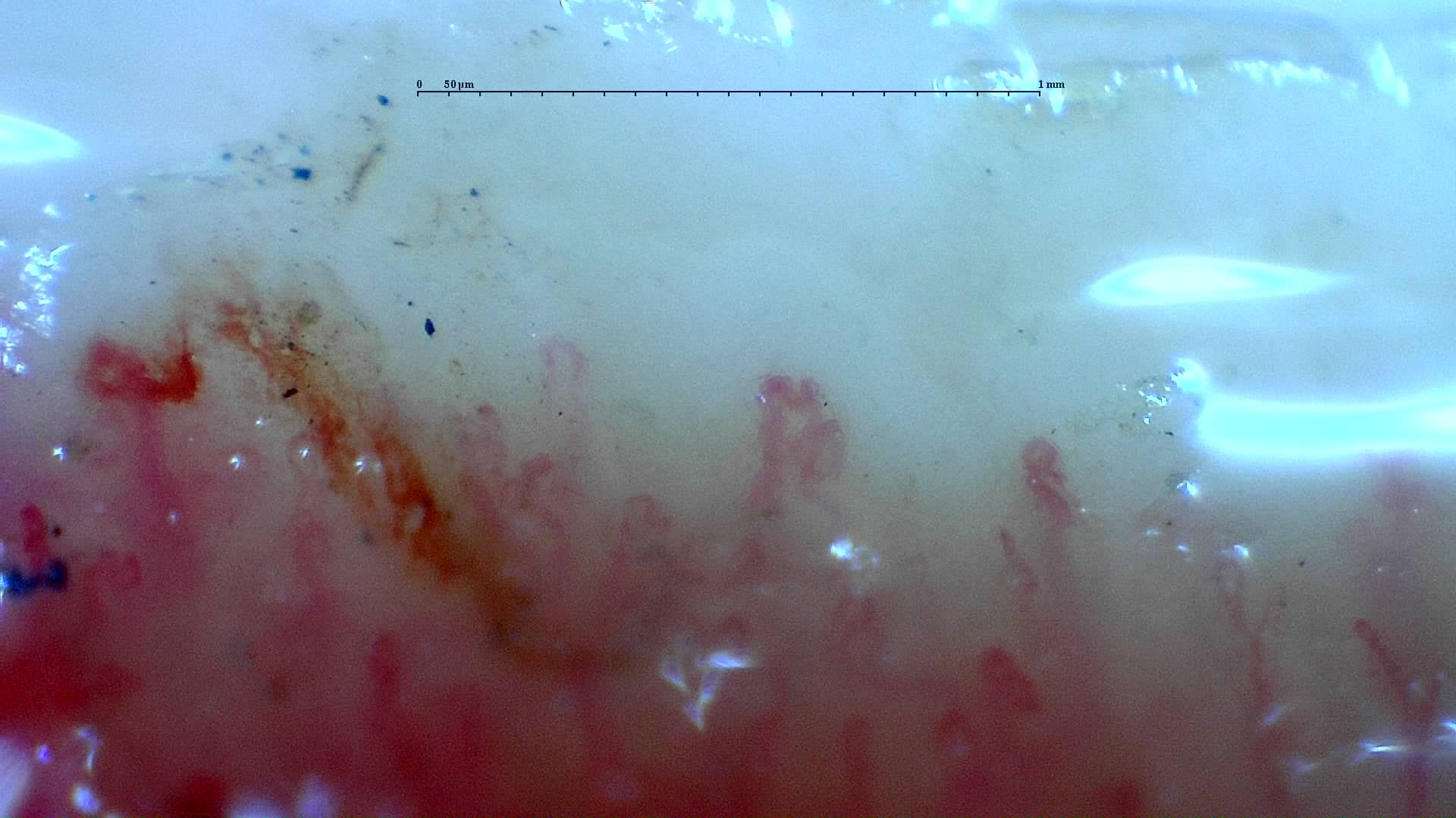 Nailfold capillaroscopy: left middle finger, field d. Mixed Connective Tissue Disease with an Unclassifiable Scleroderma-Like Pattern.