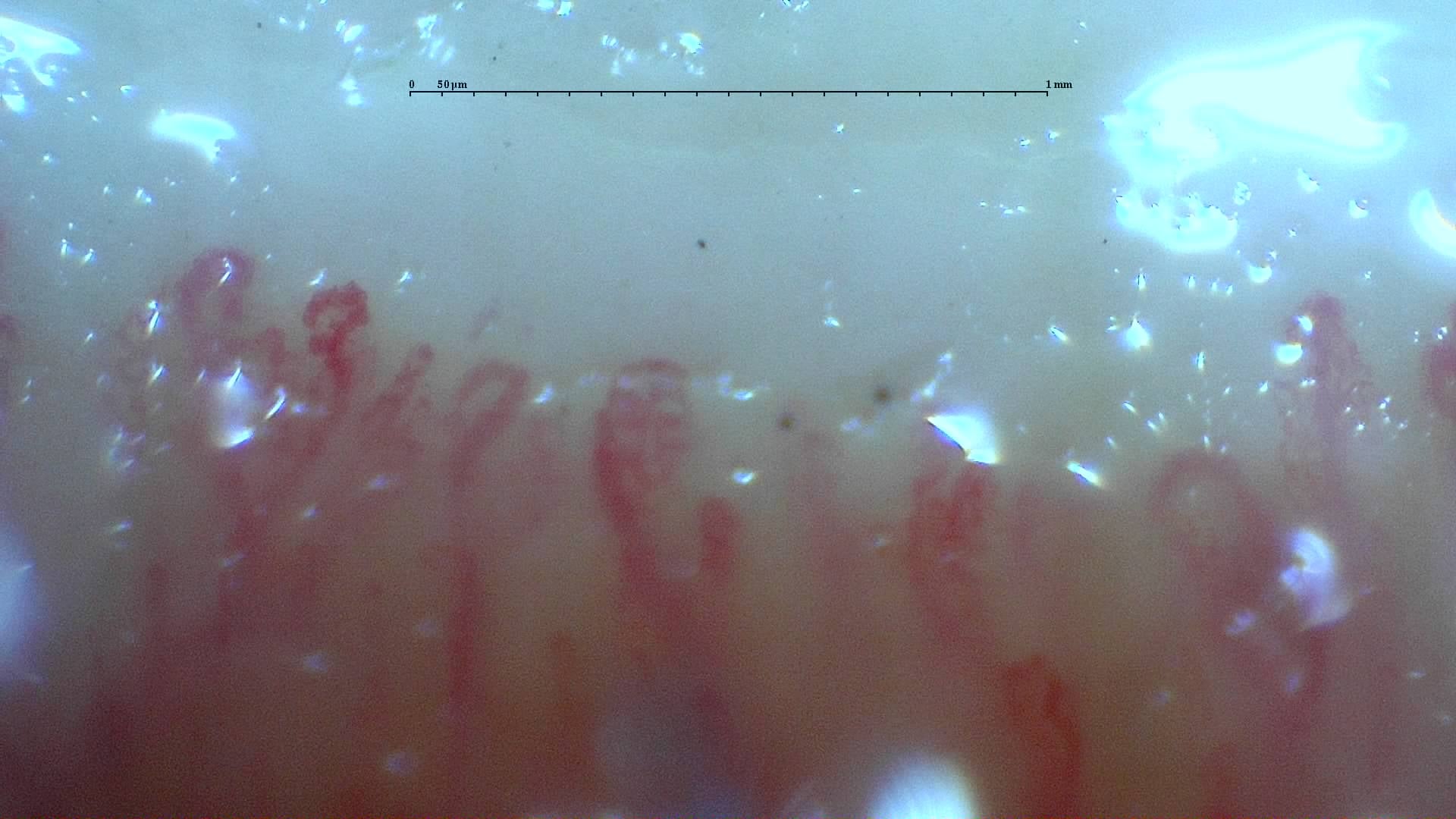 Nailfold capillaroscopy: right ring finger, field b. Mixed Connective Tissue Disease with an Unclassifiable Scleroderma-Like Pattern.