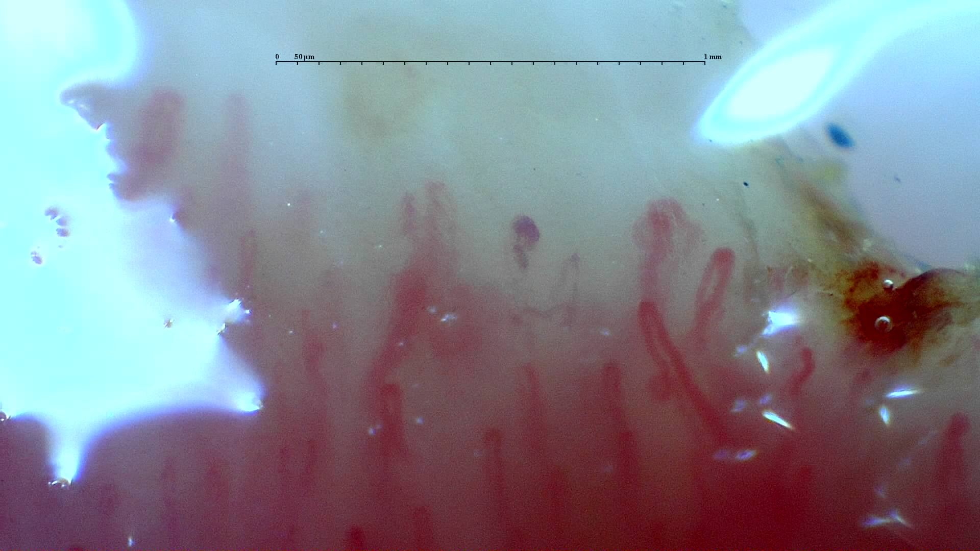 Nailfold capillaroscopy: left index finger, field d. Mixed Connective Tissue Disease with an Unclassifiable Scleroderma-Like Pattern.