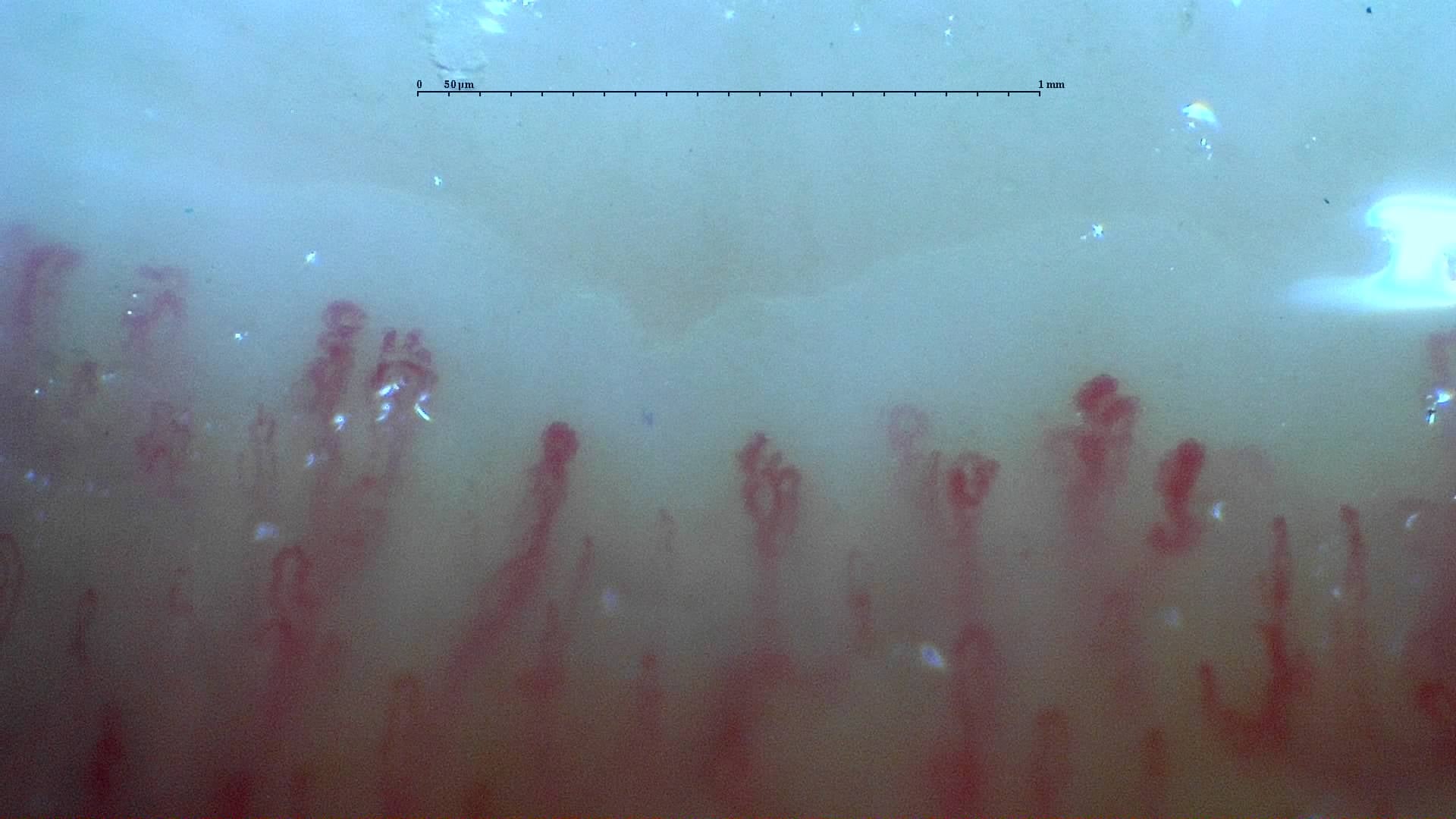 Nailfold capillaroscopy: right middle finger, field b. Mixed Connective Tissue Disease with an Unclassifiable Scleroderma-Like Pattern.