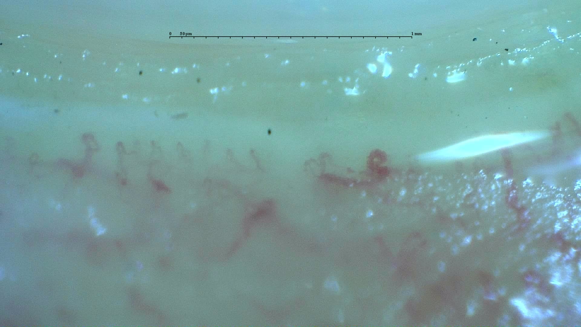 Nailfold capillaroscopy: right ring finger, field c. Anticentromere-Positive Systemic Sclerosis with Inter-Digit Pattern Heterogeneity.