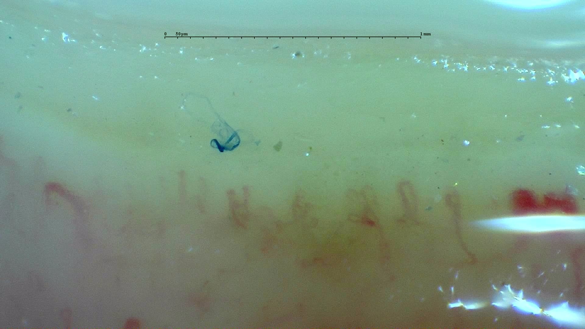 Nailfold capillaroscopy: right little finger, field b. Anticentromere-Positive Systemic Sclerosis with Inter-Digit Pattern Heterogeneity.