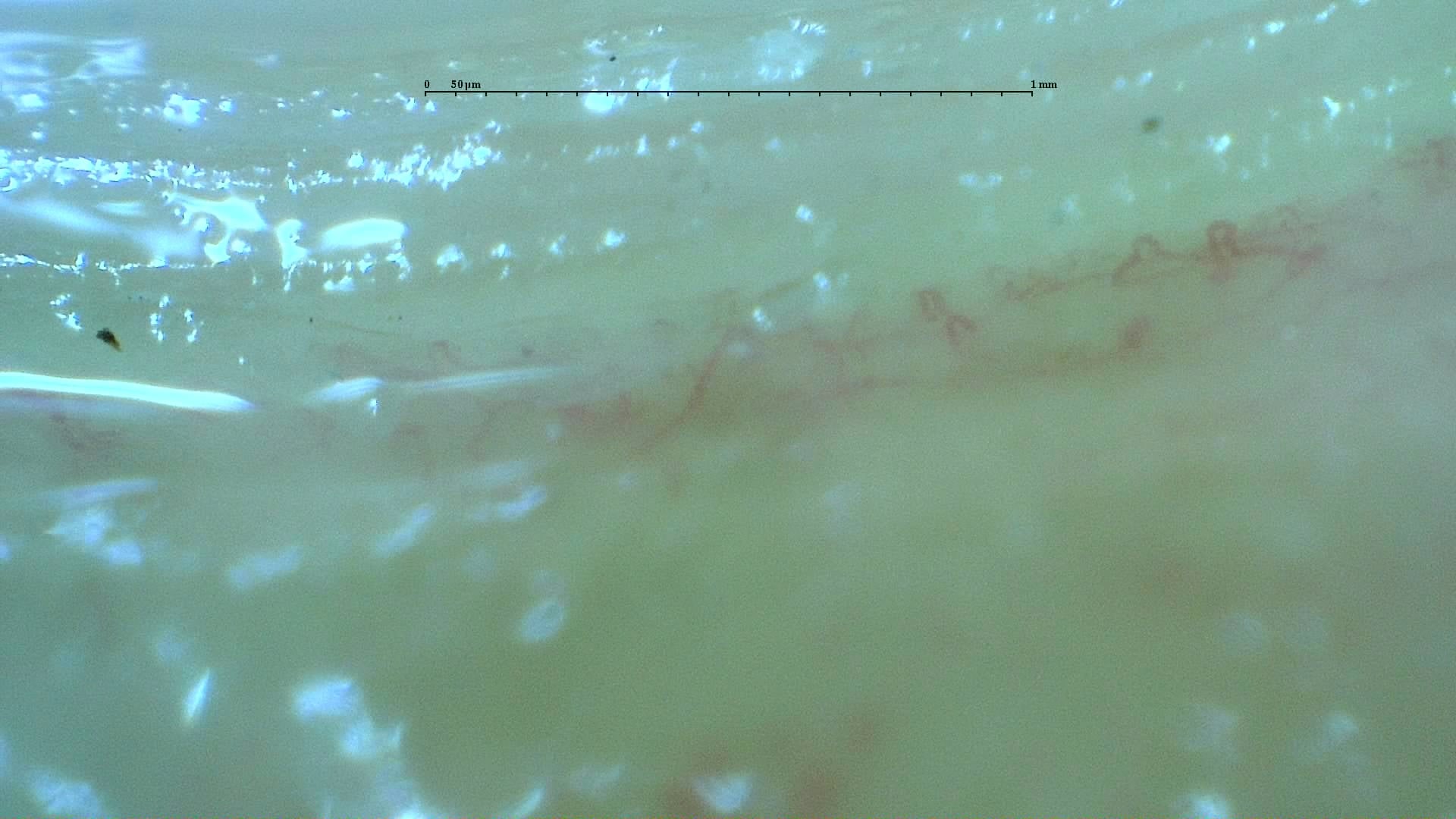 Nailfold capillaroscopy: right index finger, field b. Anticentromere-Positive Systemic Sclerosis with Inter-Digit Pattern Heterogeneity.