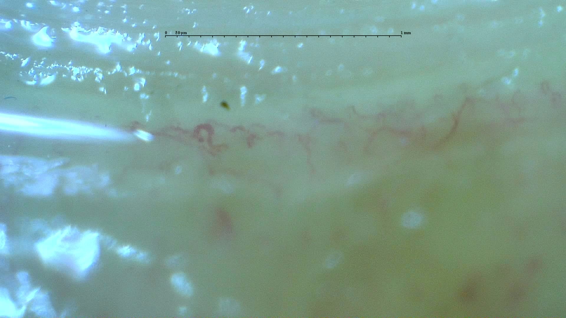 Nailfold capillaroscopy: right index finger, field d. Anticentromere-Positive Systemic Sclerosis with Inter-Digit Pattern Heterogeneity.