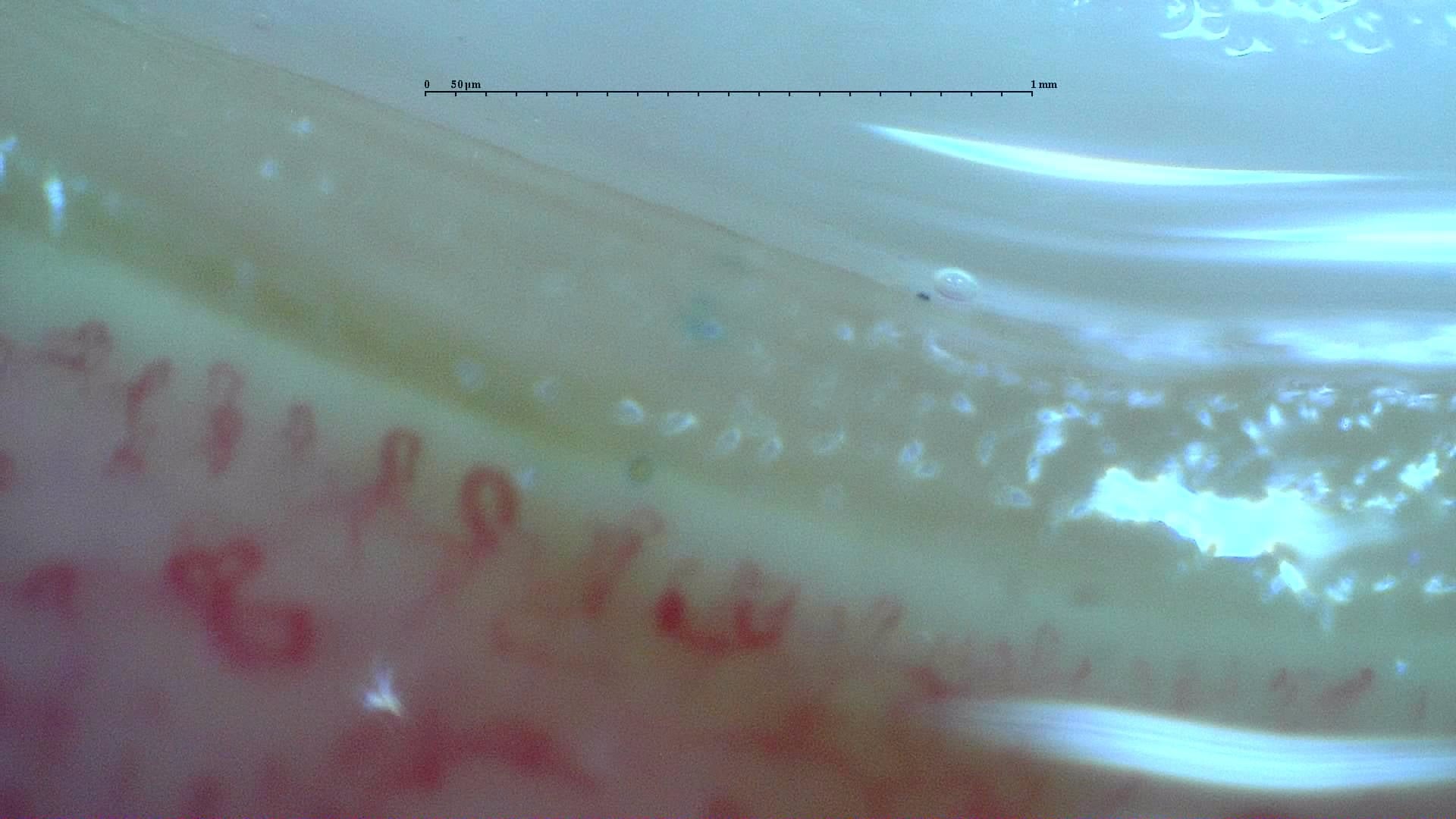 Nailfold capillaroscopy: left middle finger, field b. Anticentromere-Positive Systemic Sclerosis with Inter-Digit Pattern Heterogeneity.