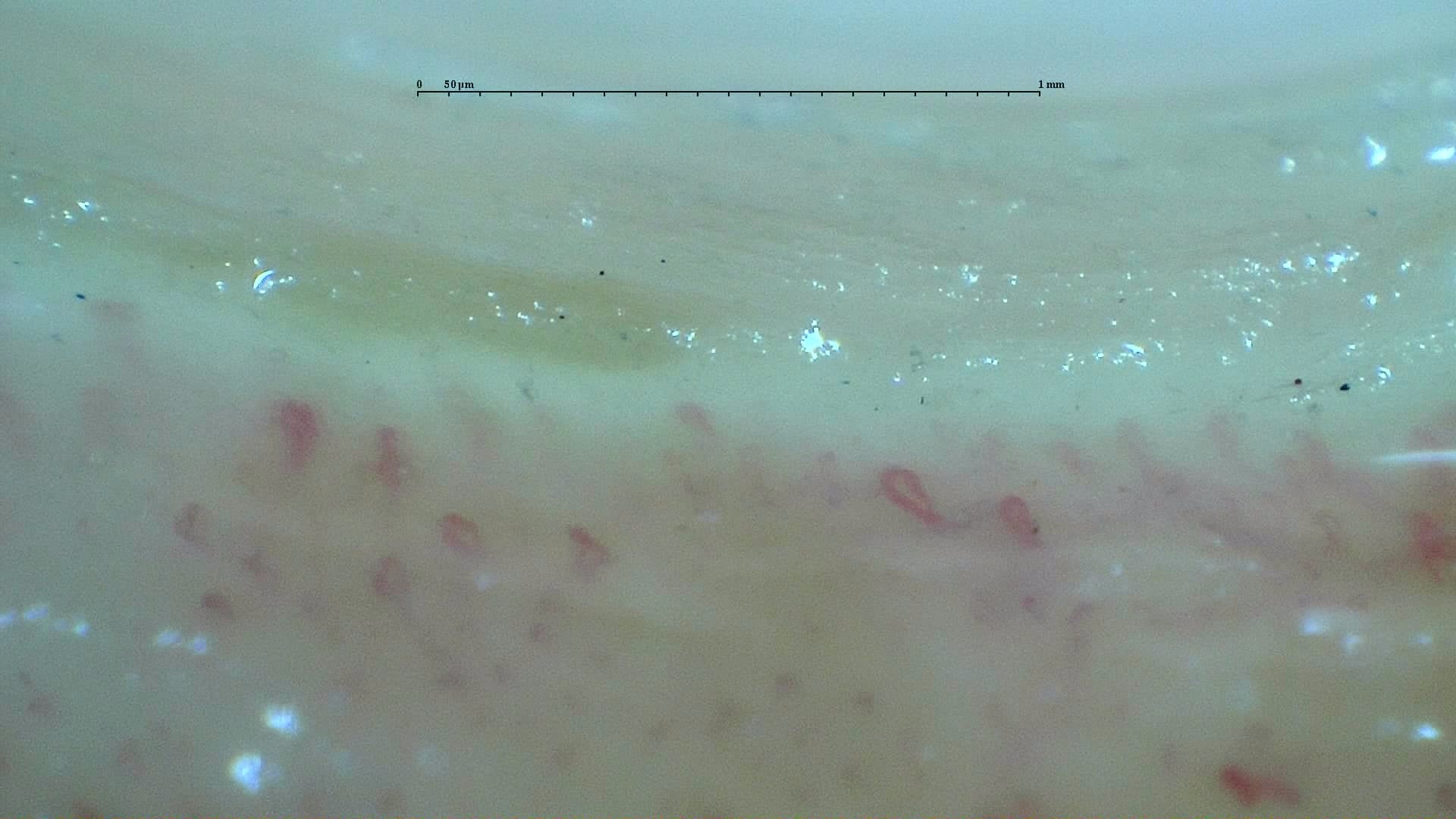 Nailfold capillaroscopy: right middle finger, field c. Anticentromere-Positive Systemic Sclerosis with Inter-Digit Pattern Heterogeneity.