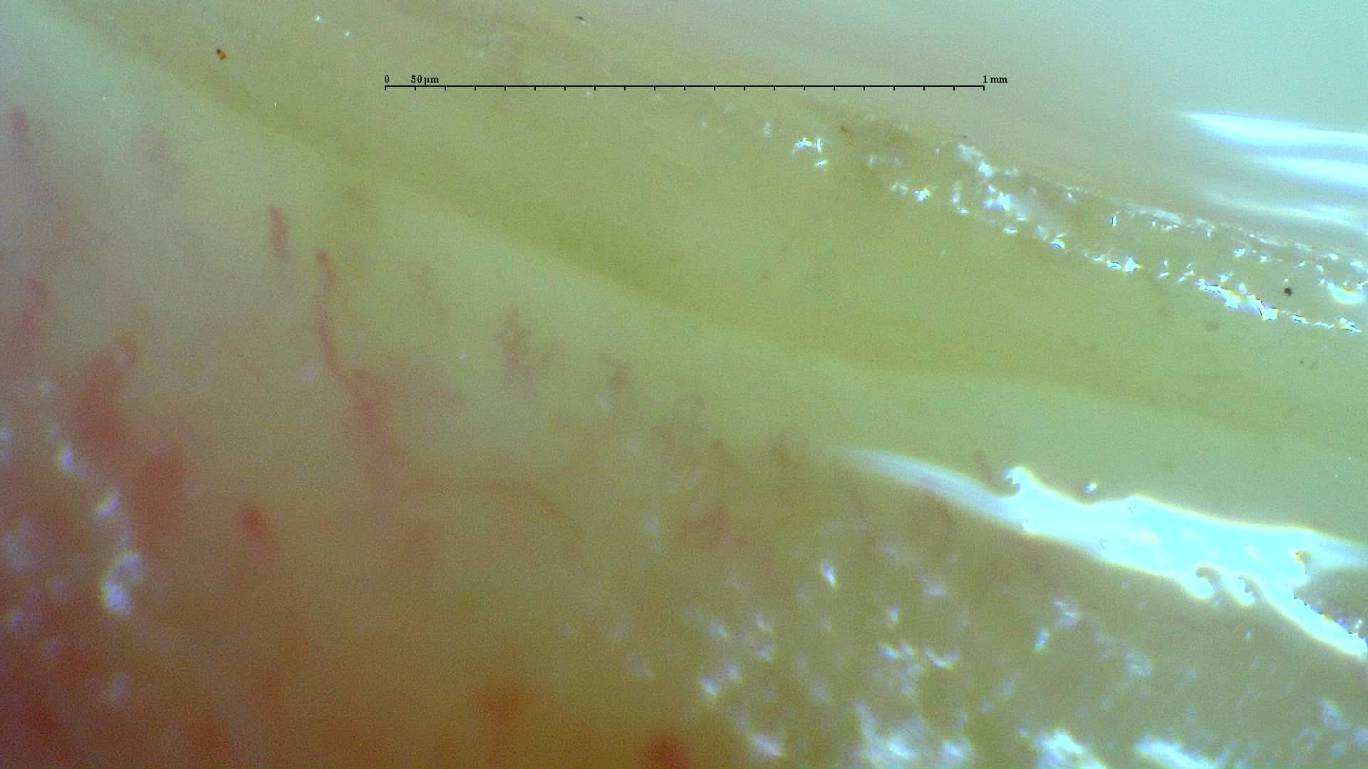 Nailfold capillaroscopy: right little finger, field d. Anticentromere-Positive Systemic Sclerosis with Inter-Digit Pattern Heterogeneity.