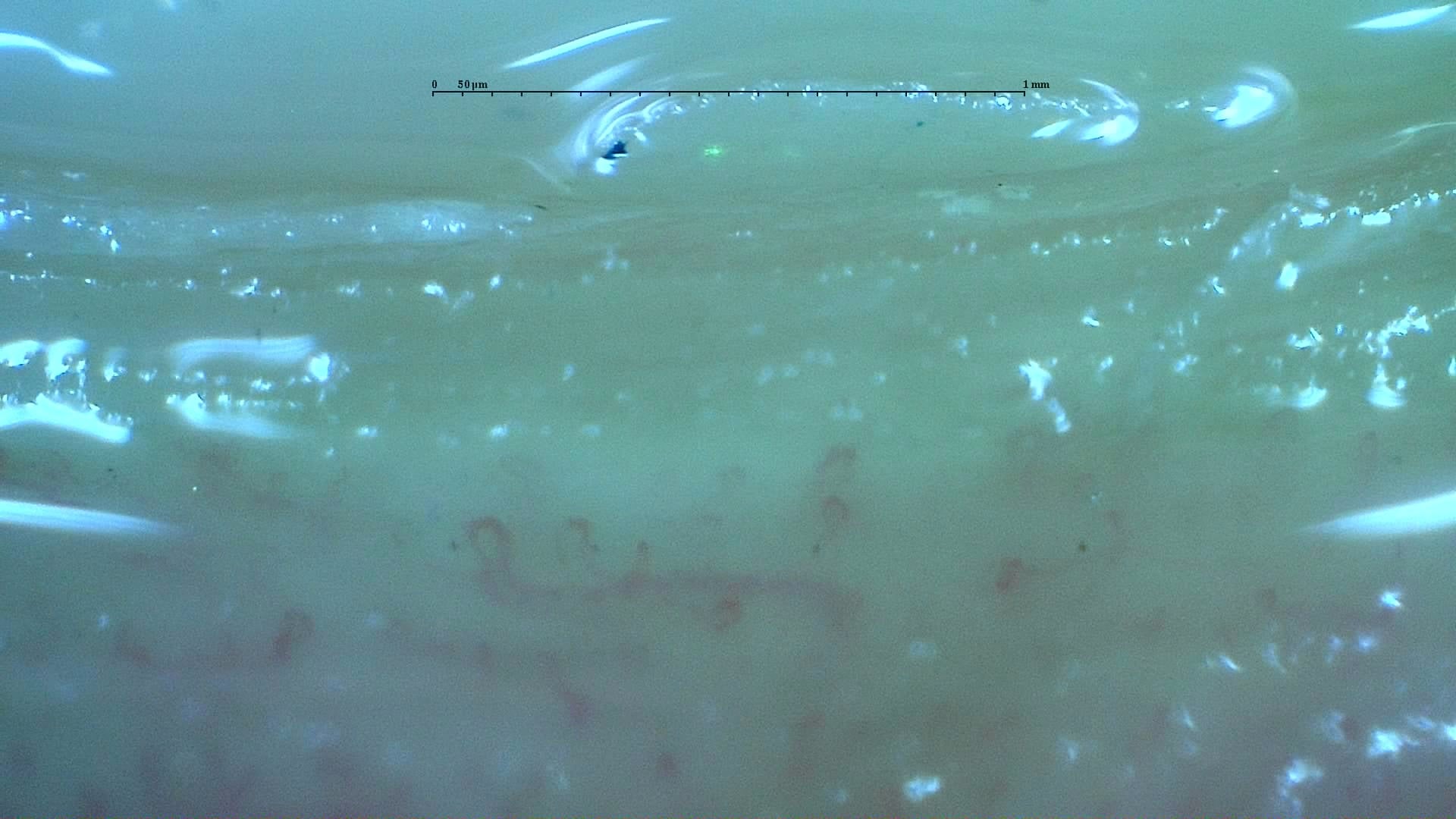 Nailfold capillaroscopy: right index finger, field a. Anticentromere-Positive Systemic Sclerosis with Inter-Digit Pattern Heterogeneity.