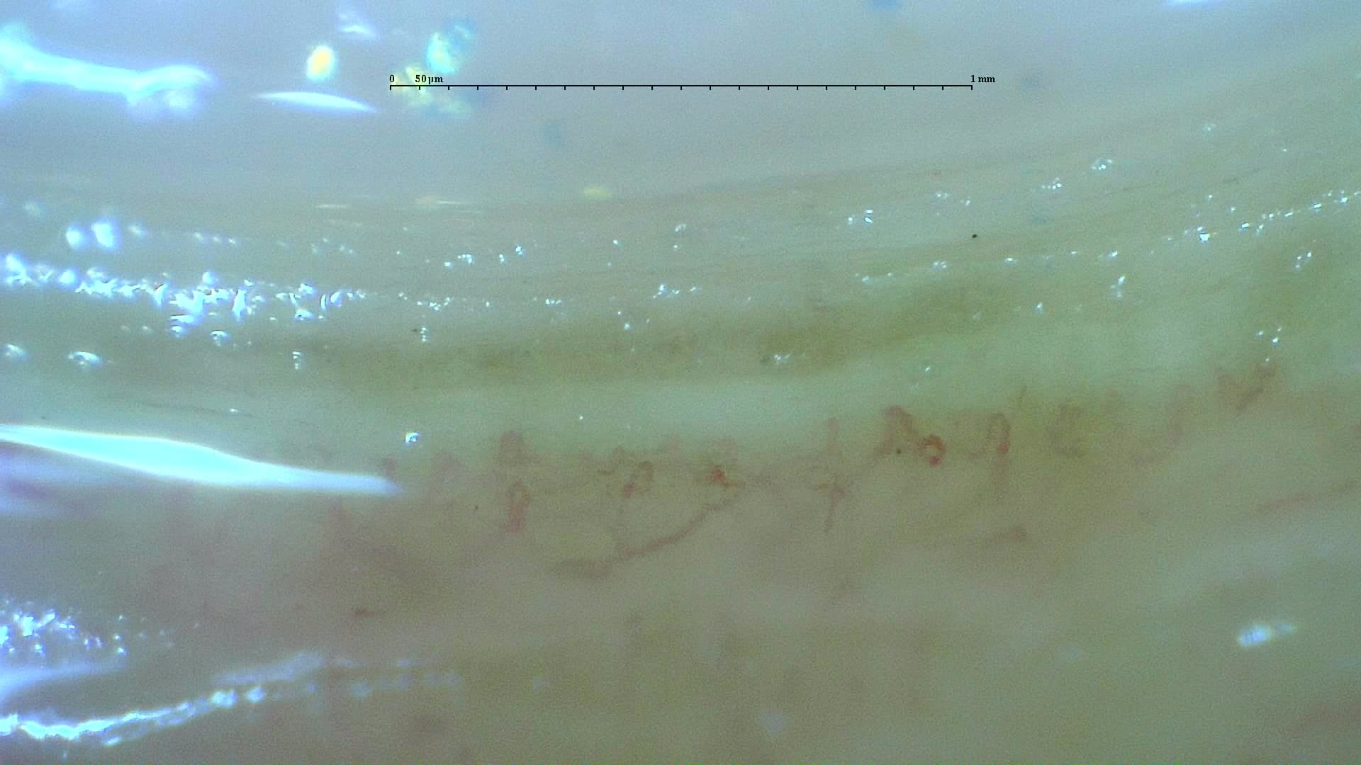 Nailfold capillaroscopy: left little finger, field c. Anticentromere-Positive Systemic Sclerosis with Inter-Digit Pattern Heterogeneity.