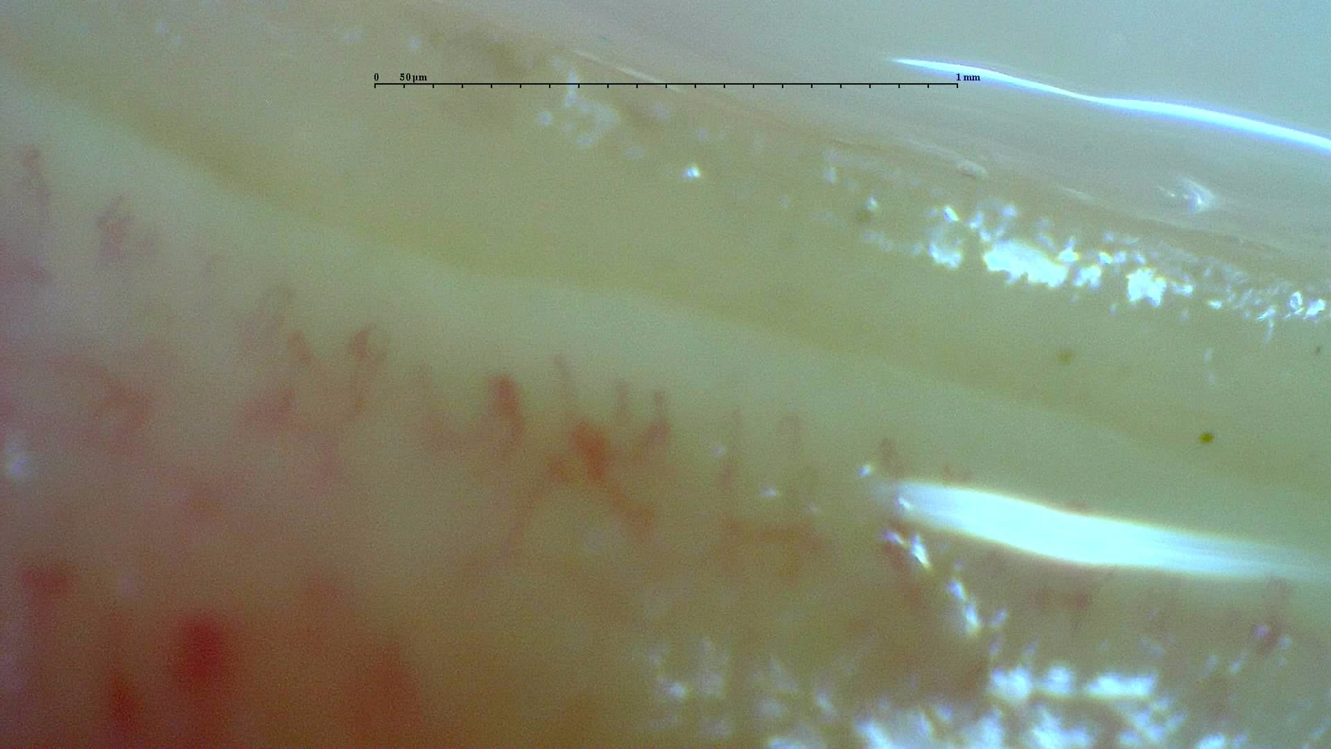 Nailfold capillaroscopy: right little finger, field c. Anticentromere-Positive Systemic Sclerosis with Inter-Digit Pattern Heterogeneity.
