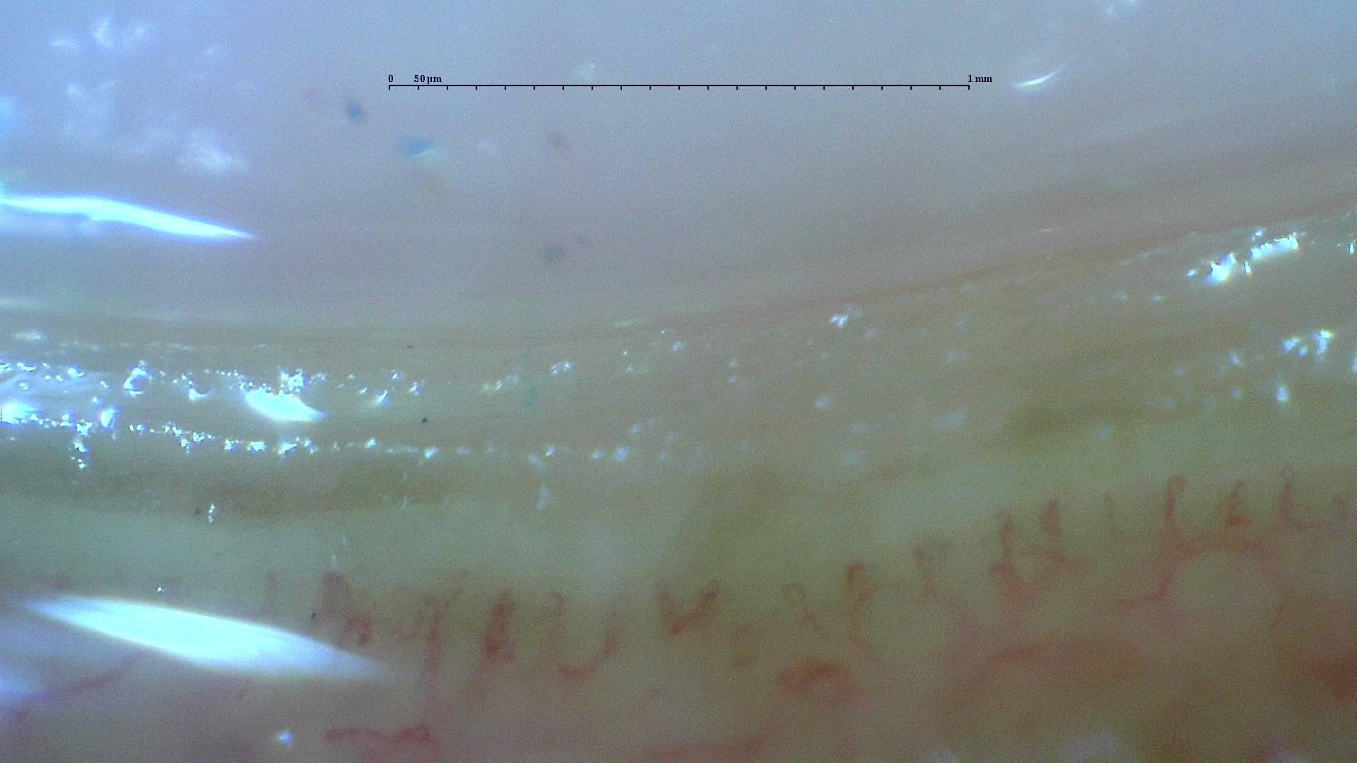 Nailfold capillaroscopy: left little finger, field b. Anticentromere-Positive Systemic Sclerosis with Inter-Digit Pattern Heterogeneity.