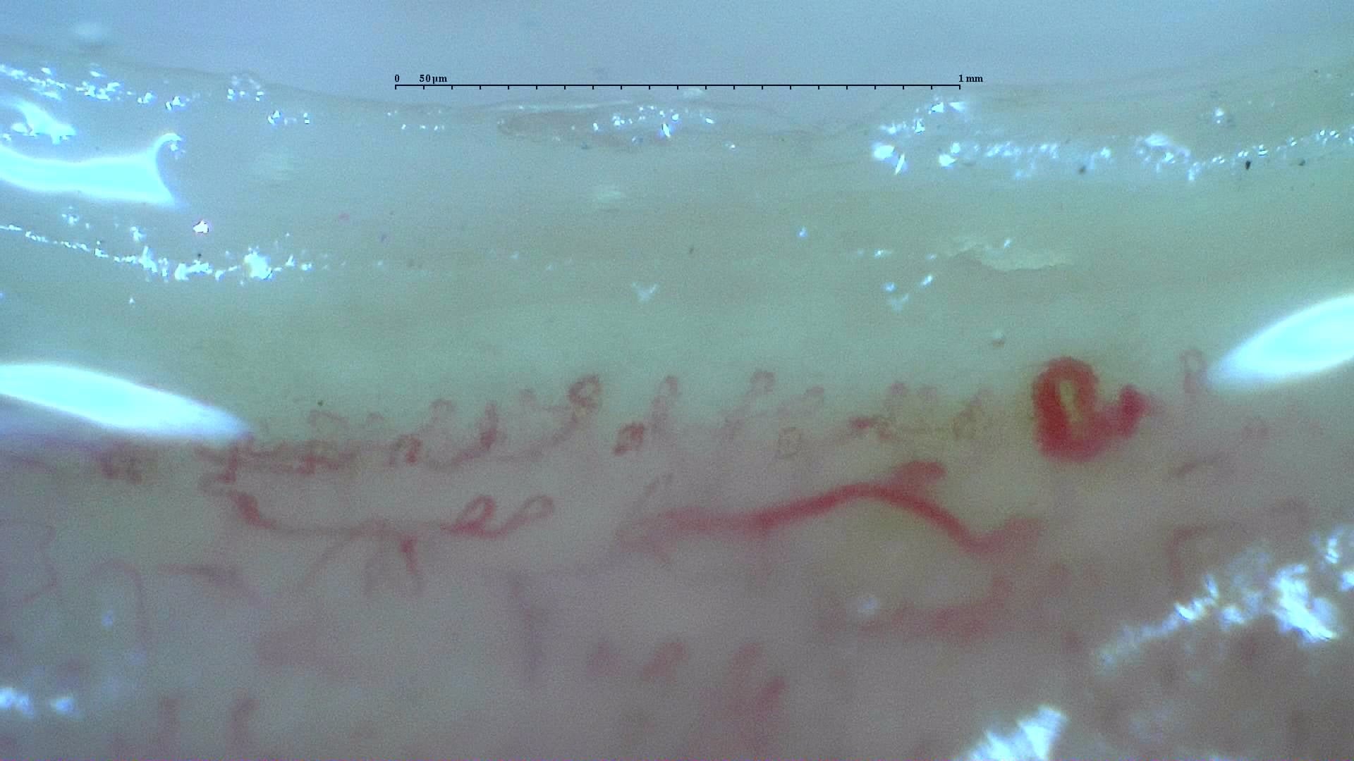 Nailfold capillaroscopy: left ring finger, field b. Anticentromere-Positive Systemic Sclerosis with Inter-Digit Pattern Heterogeneity.