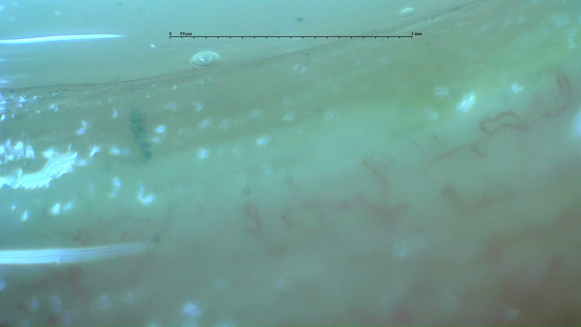 Nailfold capillaroscopy: right middle finger, field a. Anticentromere-Positive Systemic Sclerosis with Inter-Digit Pattern Heterogeneity.