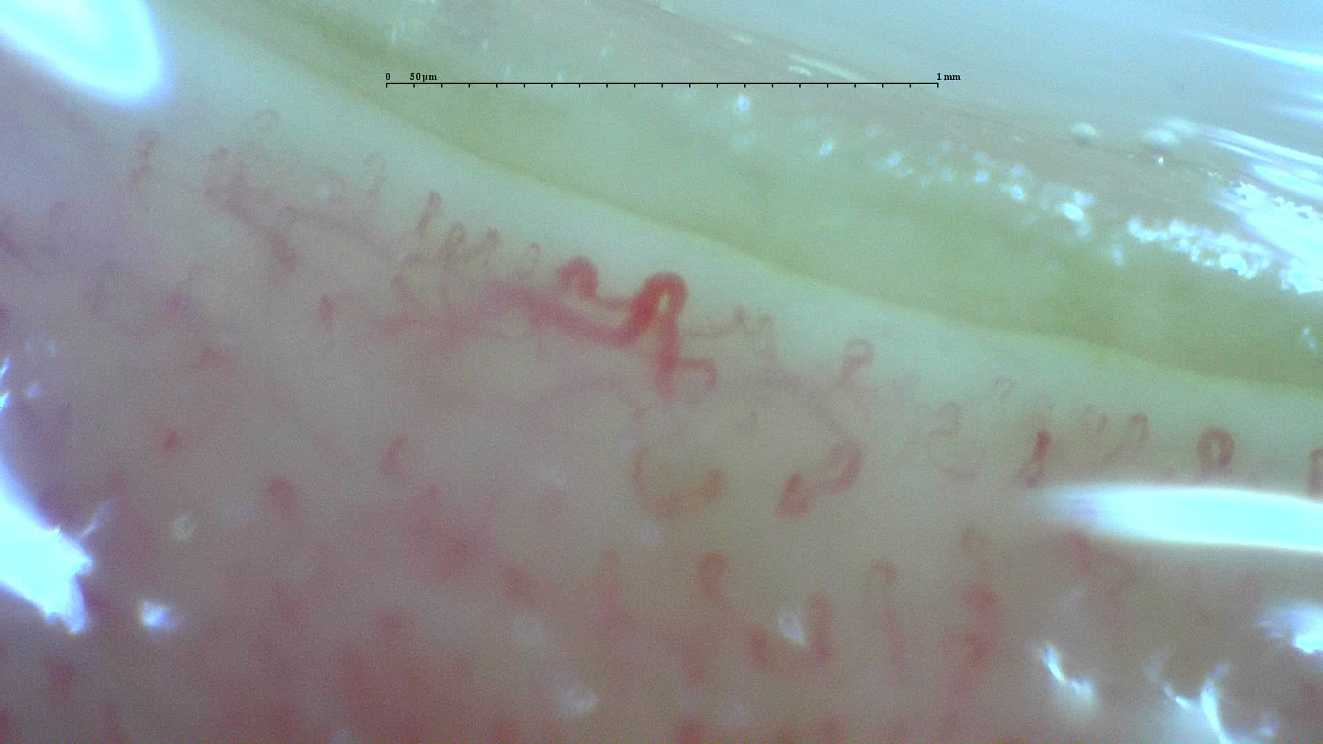 Nailfold capillaroscopy: left middle finger, field d. Anticentromere-Positive Systemic Sclerosis with Inter-Digit Pattern Heterogeneity.
