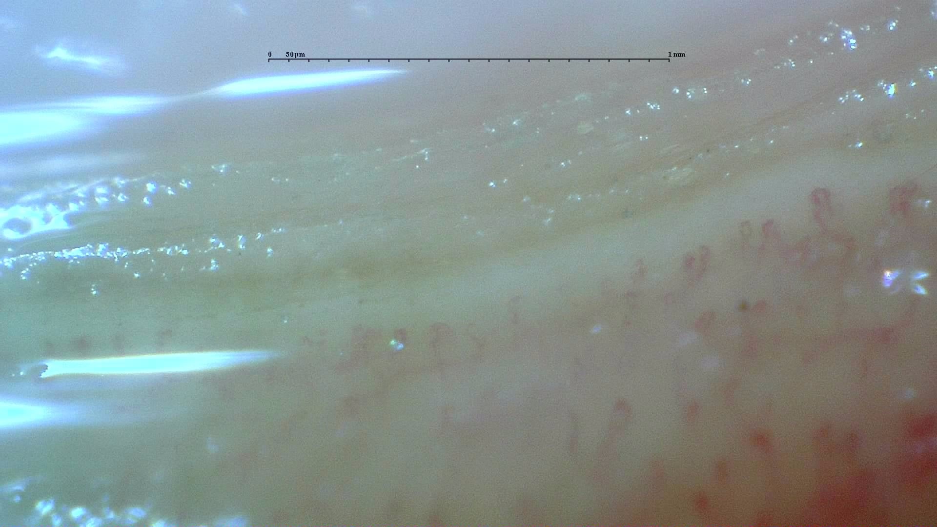 Nailfold capillaroscopy: left little finger, field a. Anticentromere-Positive Systemic Sclerosis with Inter-Digit Pattern Heterogeneity.