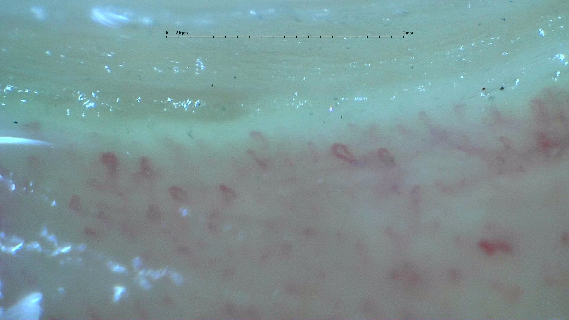 Nailfold capillaroscopy: right middle finger, field d. Anticentromere-Positive Systemic Sclerosis with Inter-Digit Pattern Heterogeneity.