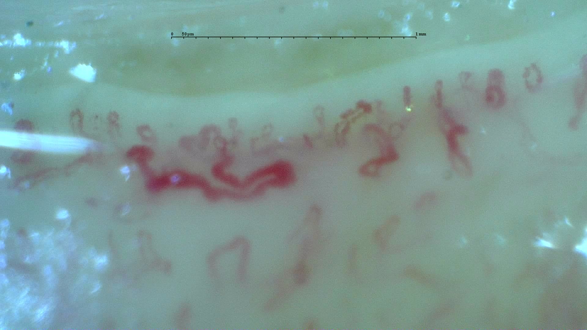 Nailfold capillaroscopy: right ring finger, field a. Anticentromere-Positive Systemic Sclerosis with Inter-Digit Pattern Heterogeneity.