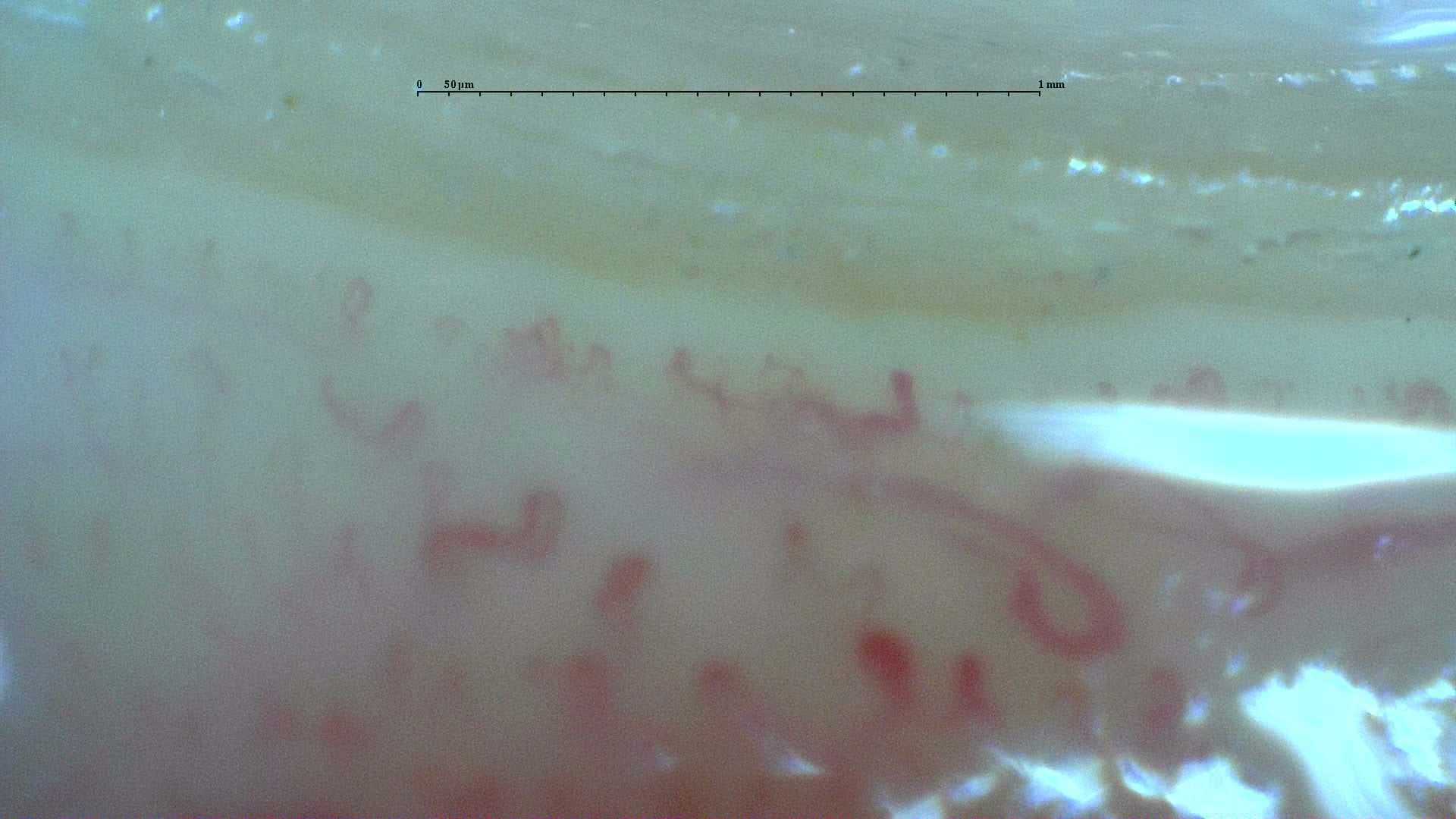 Nailfold capillaroscopy: left index finger, field c. Anticentromere-Positive Systemic Sclerosis with Inter-Digit Pattern Heterogeneity.