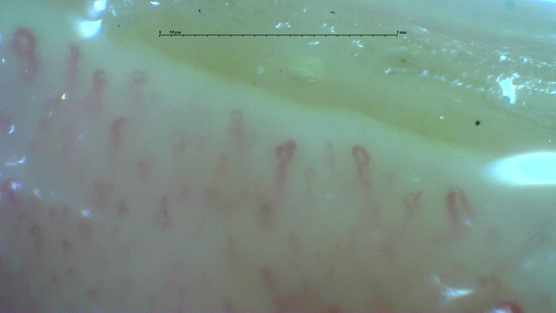 Nailfold capillaroscopy: left index finger, field d. Anticentromere-Positive Systemic Sclerosis with Inter-Digit Pattern Heterogeneity.
