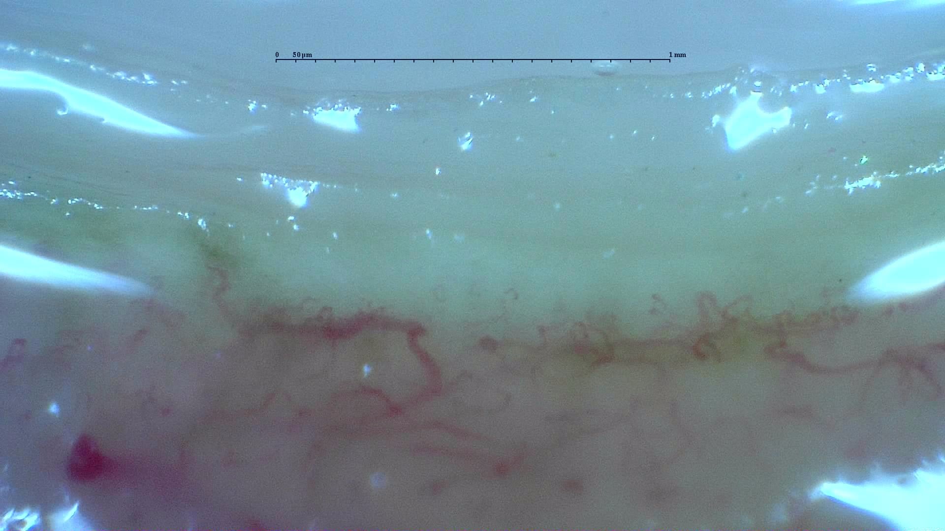 Nailfold capillaroscopy: left ring finger, field c. Anticentromere-Positive Systemic Sclerosis with Inter-Digit Pattern Heterogeneity.