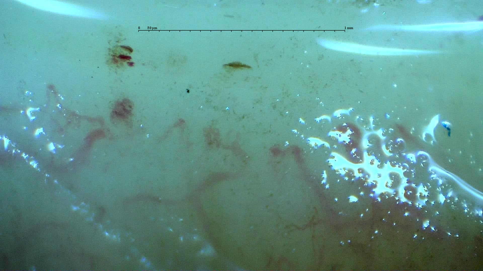 Nailfold capillaroscopy: right little finger, field c. Systemic Sclerosis with anti-U3 RNP: Late Microangiopathy.