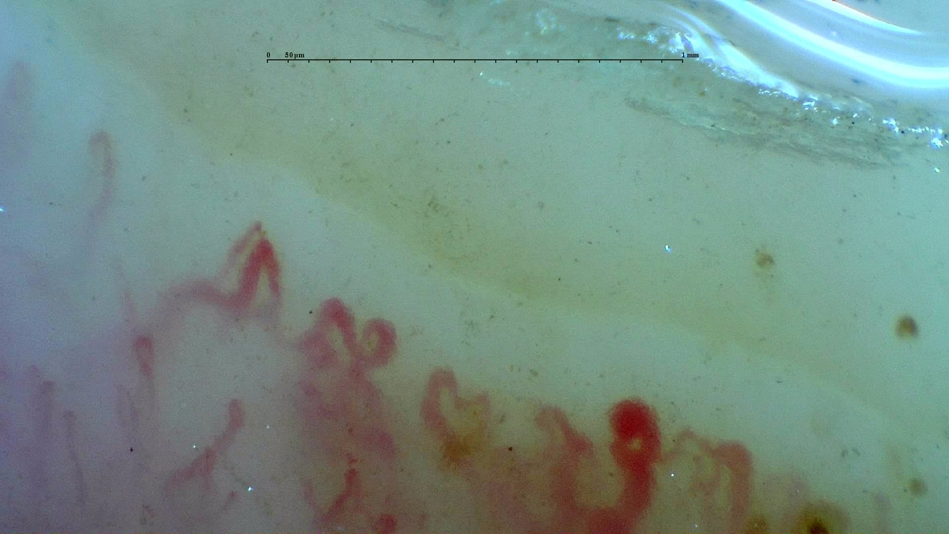 Nailfold capillaroscopy: left index finger, field d. Systemic Sclerosis with anti-U3 RNP: Late Microangiopathy.