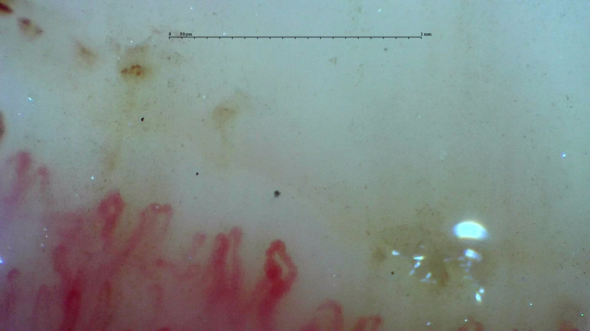 Nailfold capillaroscopy: left middle finger, field d. Systemic Sclerosis with anti-U3 RNP: Late Microangiopathy.