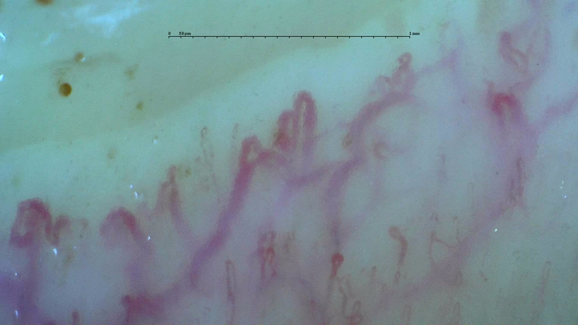 Nailfold capillaroscopy: right middle finger, field b. Systemic Sclerosis with anti-U3 RNP: Late Microangiopathy.