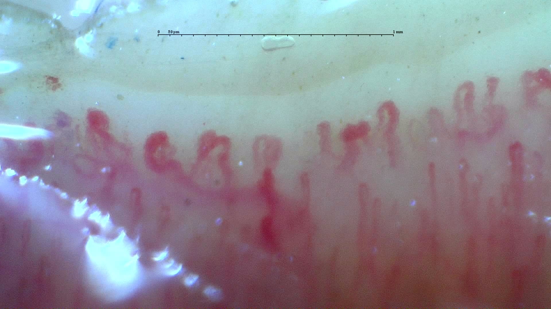 Nailfold capillaroscopy: right middle finger, field c. Systemic Sclerosis with anti-U3 RNP: Late Microangiopathy.