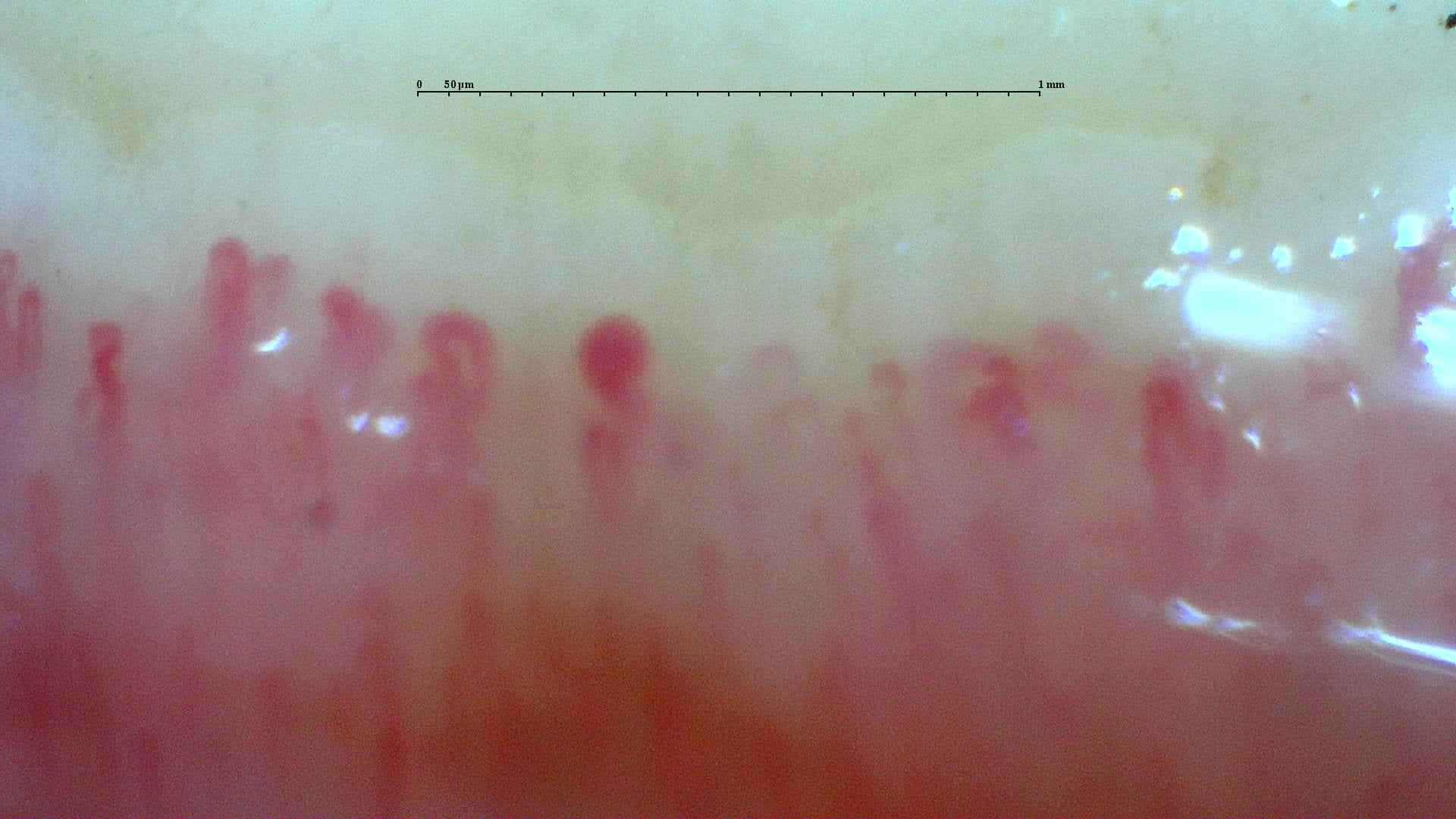 Nailfold capillaroscopy: right index finger, field d. Systemic Sclerosis with anti-U3 RNP: Late Microangiopathy.